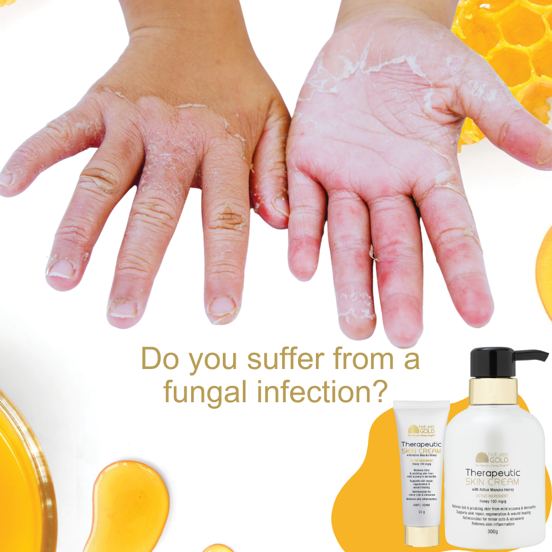 Can Manuka honey heal fungal infections?