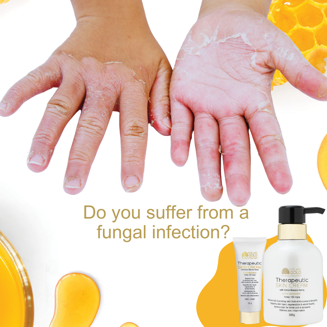 Can Manuka honey heal fungal infections? – Natures Gold