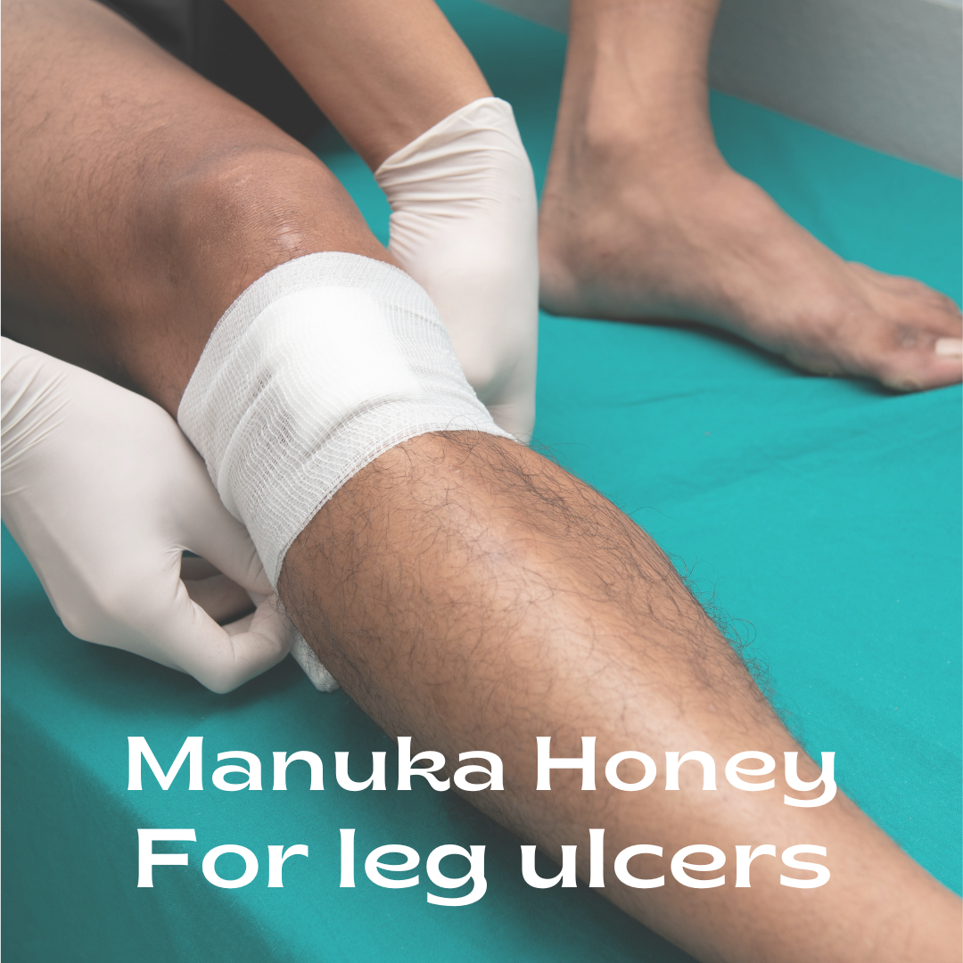 Is Manuka honey good for healing leg ulcers?