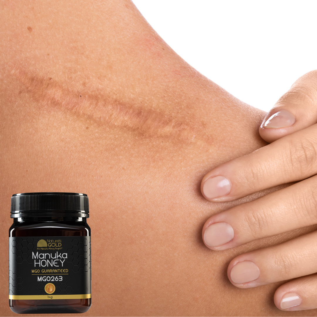 Can Manuka honey be used to remove scars?